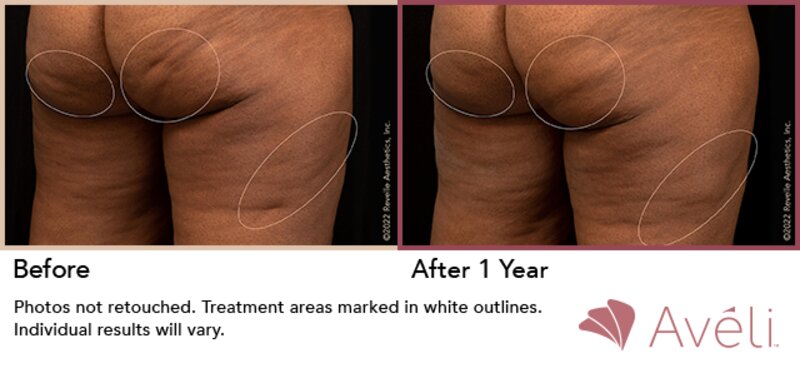 Cellulite Treatment Lafayette, LA  Lafayette