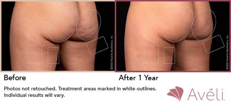 Cellulite Treatment Lafayette, LA  Lafayette