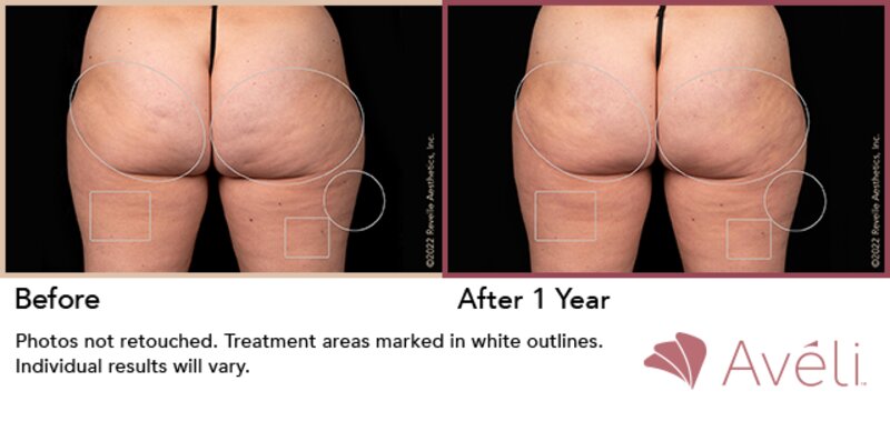 Cellulite Treatment Lafayette, LA  Lafayette