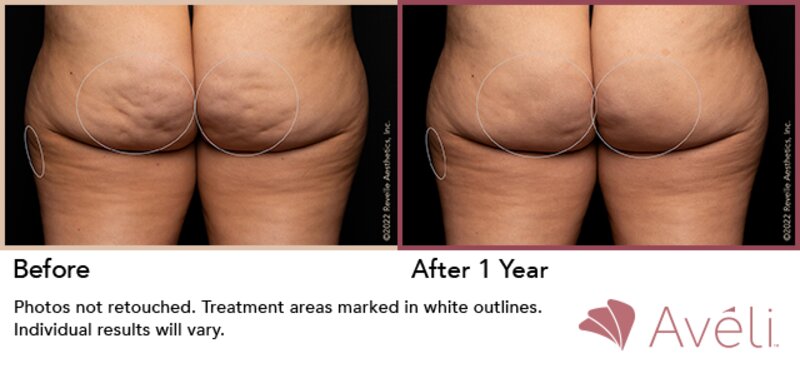 Cellulite Treatment Lafayette, LA  Lafayette