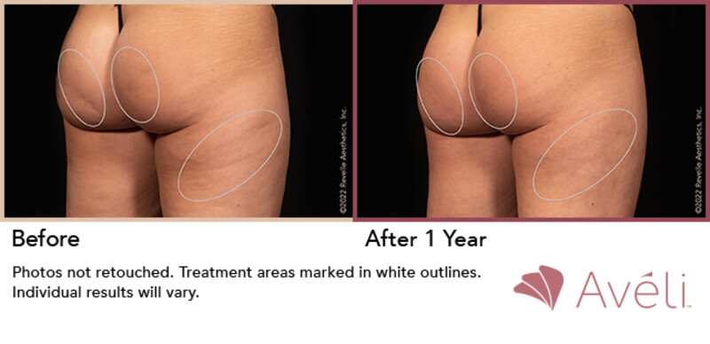 Cellulite Treatment Lafayette, LA  Lafayette