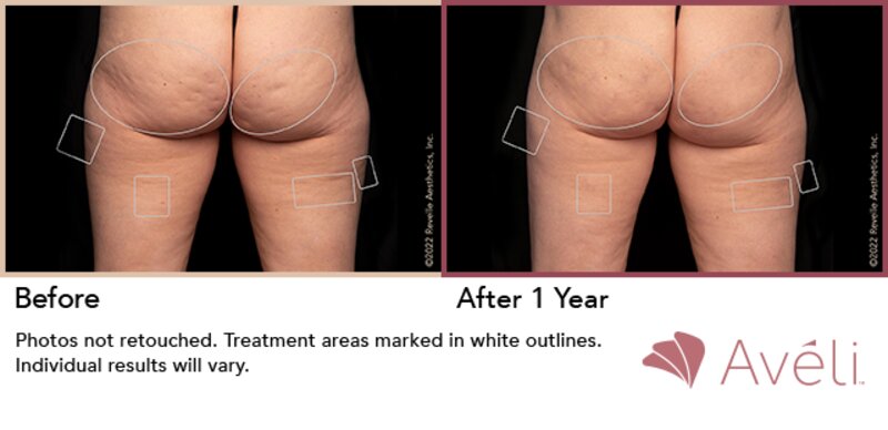 Cellulite Treatment Lafayette, LA  Lafayette