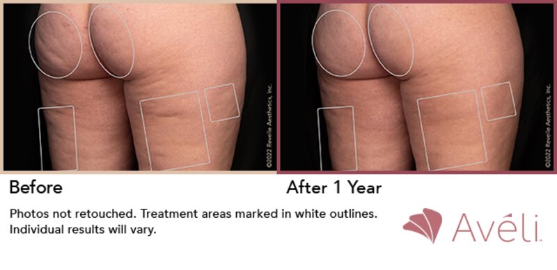 Cellulite Treatment Lafayette, LA  Lafayette