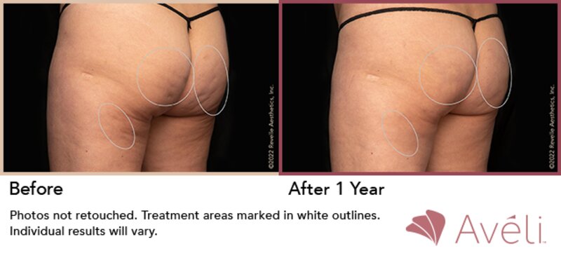 Cellulite Treatment Lafayette, LA  Lafayette