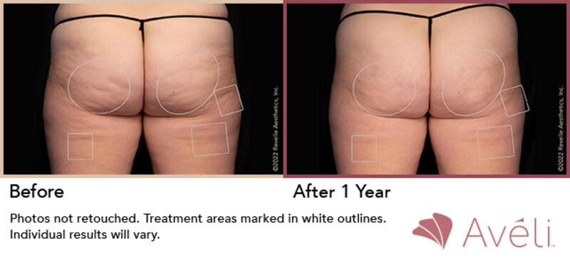 Cellulite Treatment Lafayette, LA  Lafayette