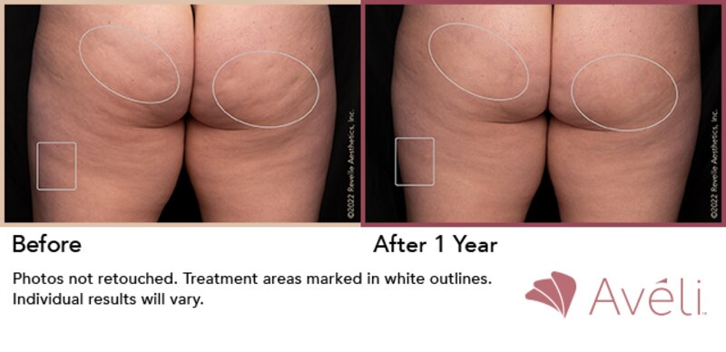 Cellulite Treatment Lafayette, LA  Lafayette