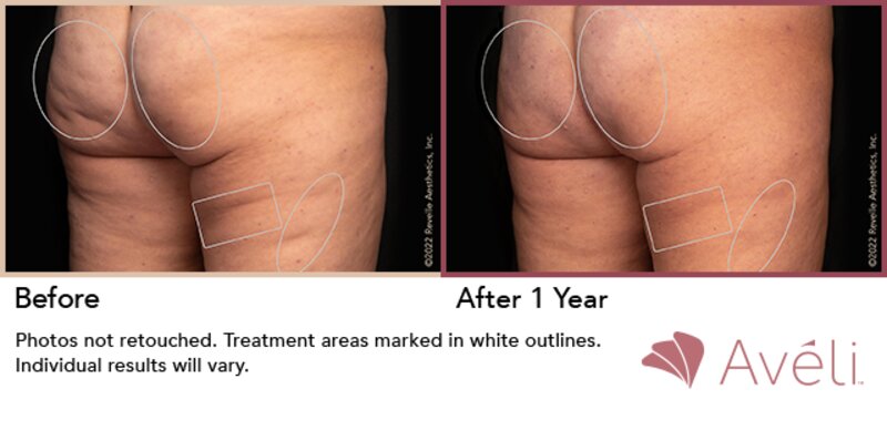 Cellulite Treatment Lafayette, LA  Lafayette