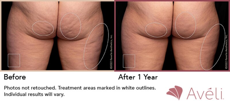 Cellulite Treatment Lafayette, LA  Lafayette