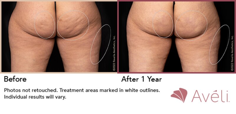 Cellulite Treatment Lafayette, LA  Lafayette