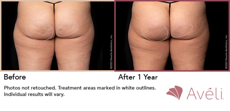 Cellulite Treatment Lafayette, LA  Lafayette