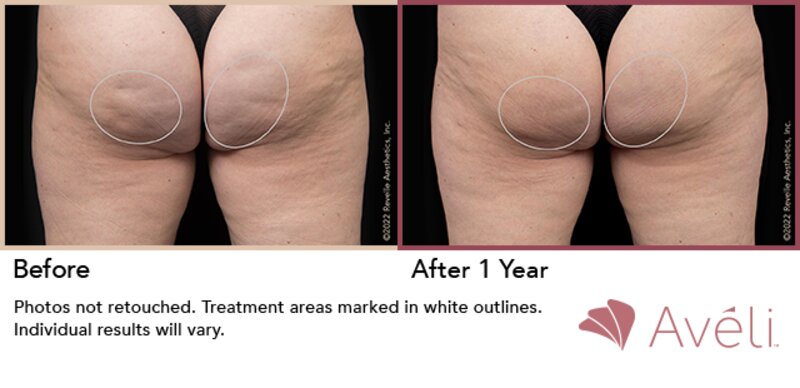 Cellulite Treatment Lafayette, LA  Lafayette