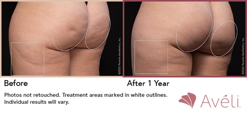 Cellulite Treatment Lafayette, LA  Lafayette