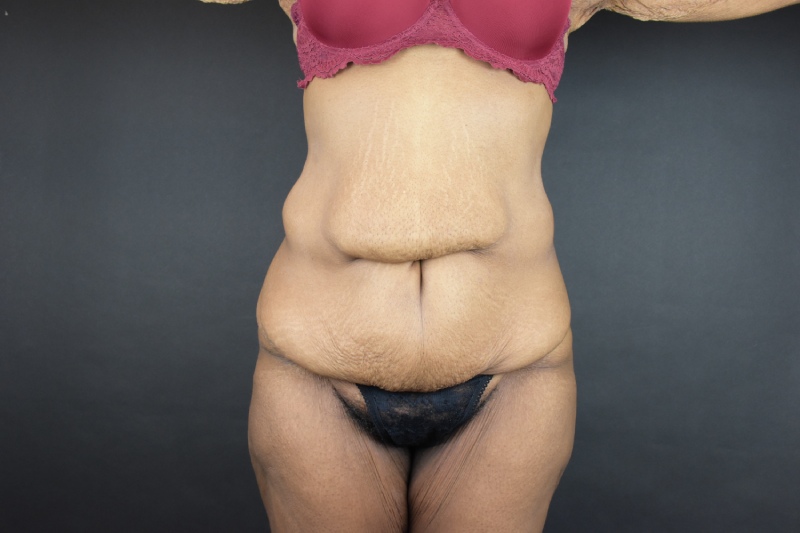 Abdominoplasty With Lipo Before & After Image