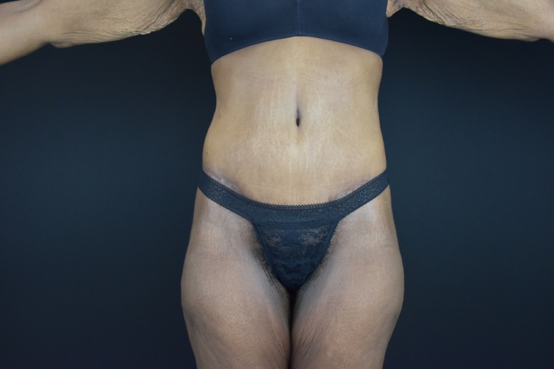 Abdominoplasty With Lipo Before & After Image