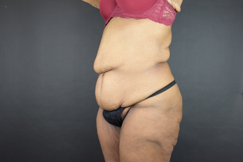 Abdominoplasty With Lipo Before & After Image