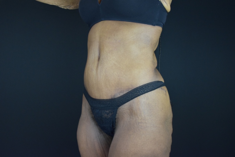 Abdominoplasty With Lipo Before & After Image