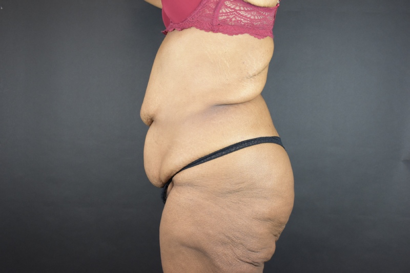 Abdominoplasty With Lipo Before & After Image
