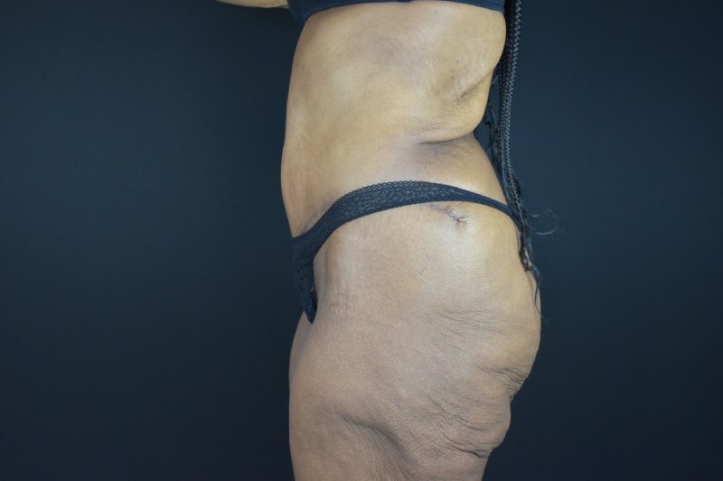Abdominoplasty With Lipo Before & After Image