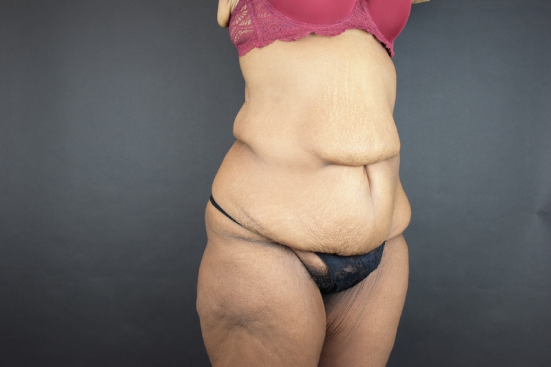 Abdominoplasty With Lipo Before & After Image