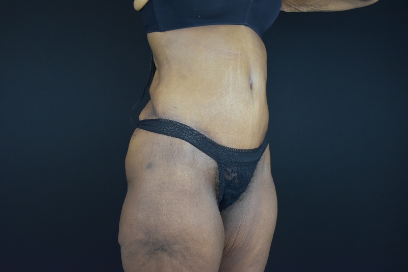 Abdominoplasty With Lipo Before & After Image