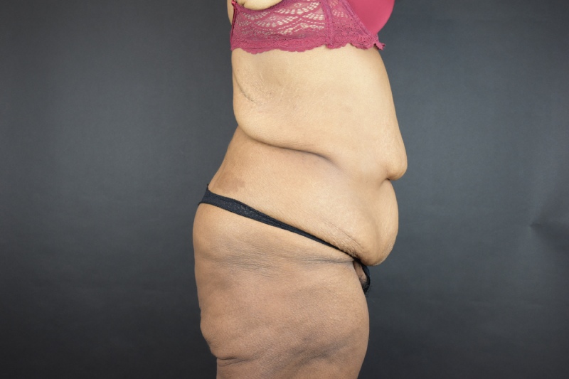 Abdominoplasty With Lipo Before & After Image
