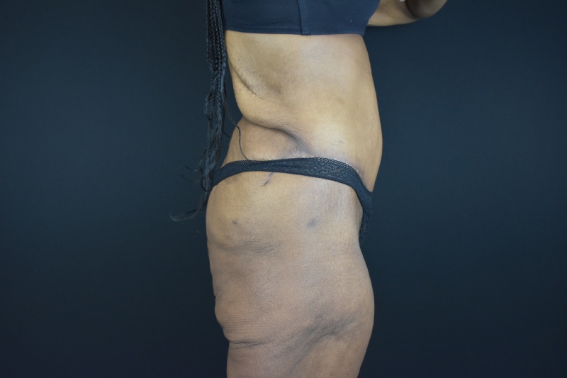 Abdominoplasty With Lipo Before & After Image