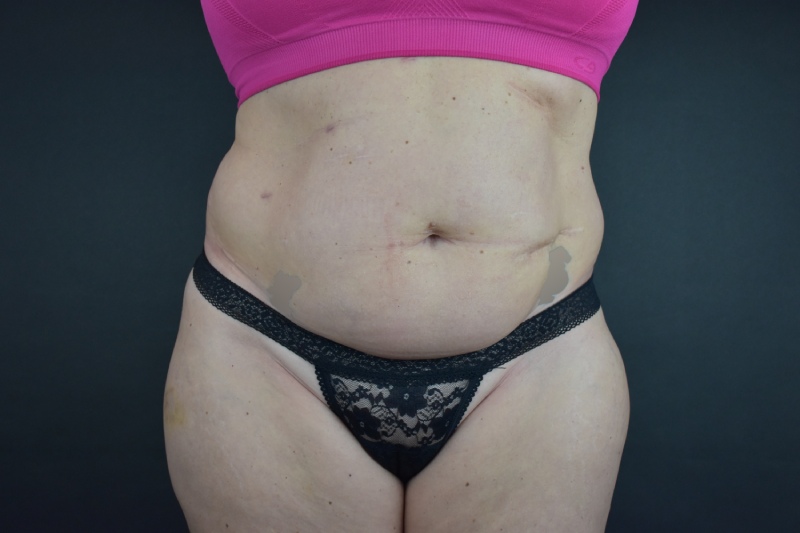 Abdominoplasty With Lipo Before & After Image