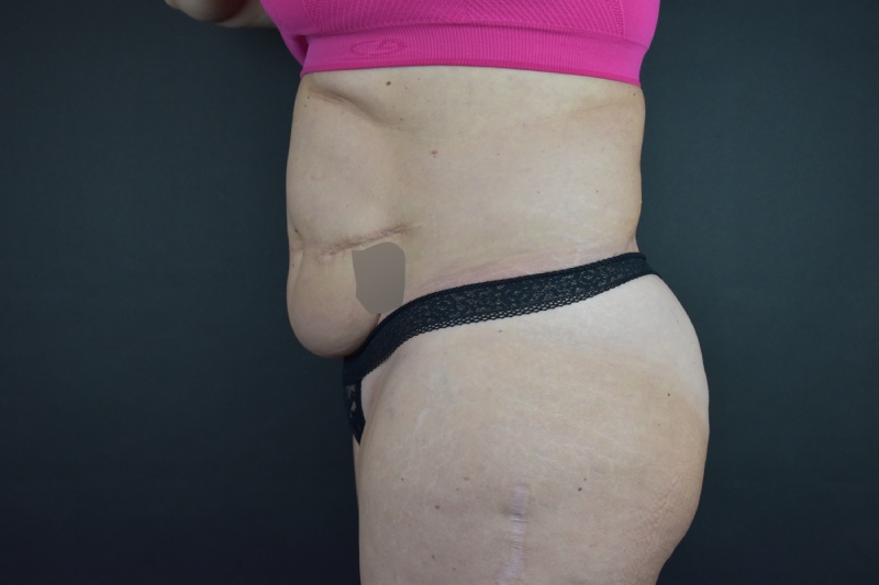 Abdominoplasty With Lipo Before & After Image