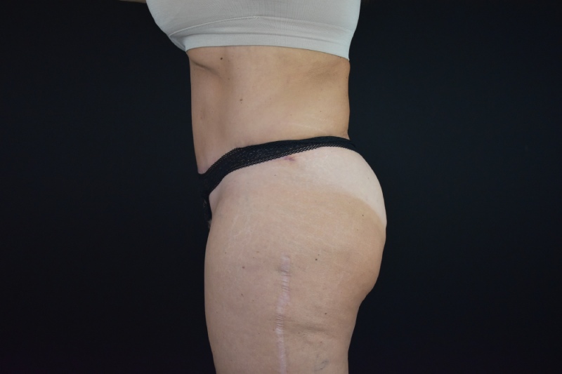 Abdominoplasty With Lipo Before & After Image