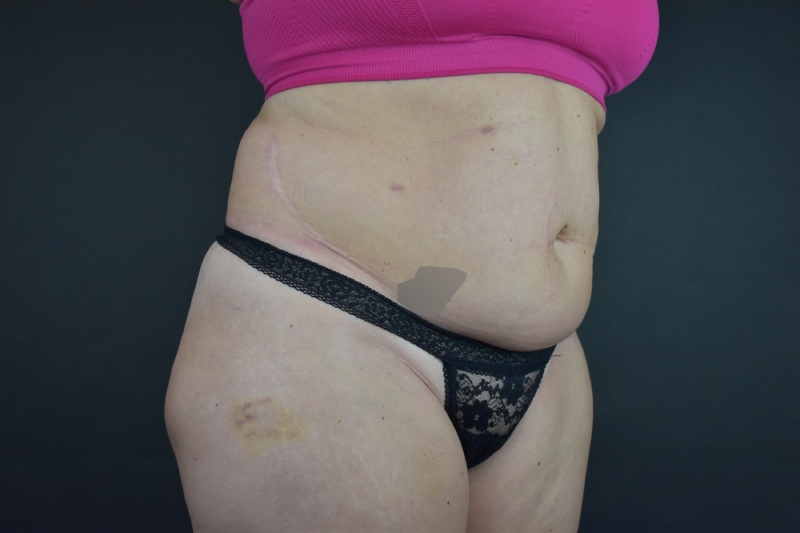 Abdominoplasty With Lipo Before & After Image