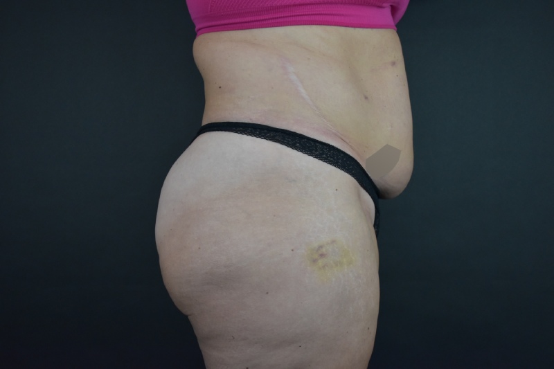 Abdominoplasty With Lipo Before & After Image