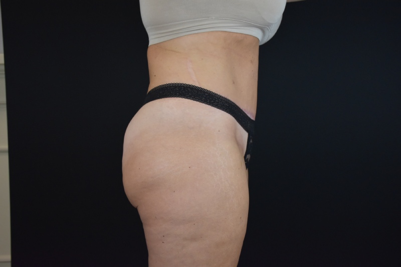 Abdominoplasty With Lipo Before & After Image