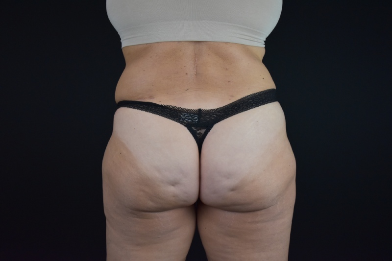 Abdominoplasty With Lipo Before & After Image