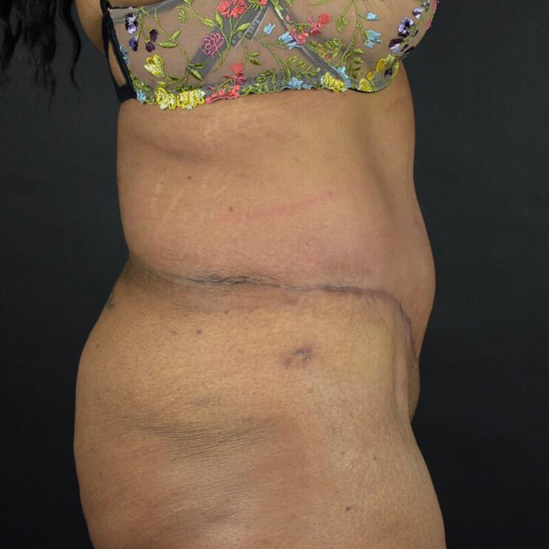 Abdominoplasty w/out Lipo Before & After Image