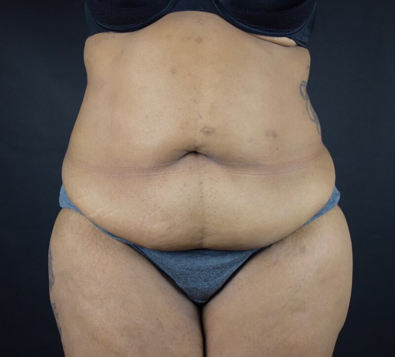 Abdominoplasty w/out Lipo Before & After Image