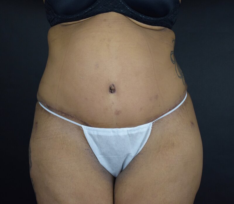 Abdominoplasty w/out Lipo Before & After Image
