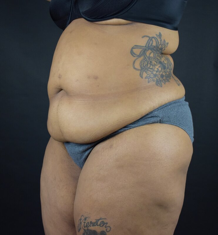 Abdominoplasty w/out Lipo Before & After Image