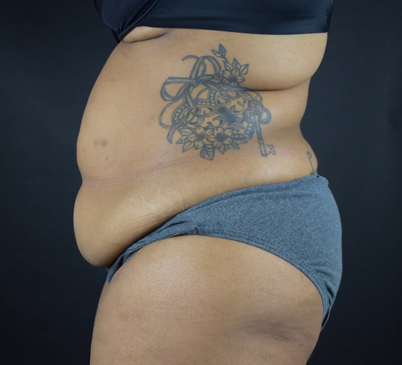 Abdominoplasty w/out Lipo Before & After Image