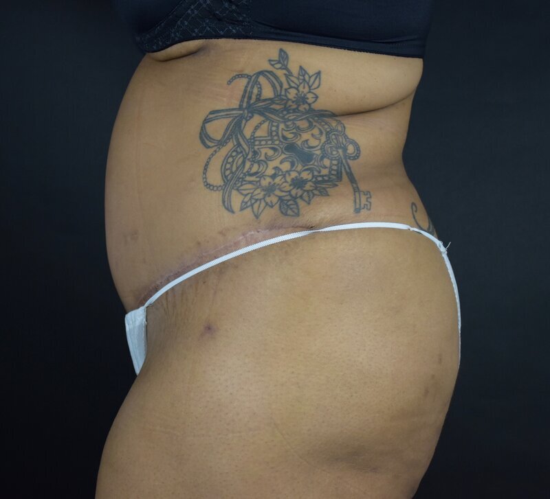 Abdominoplasty w/out Lipo Before & After Image