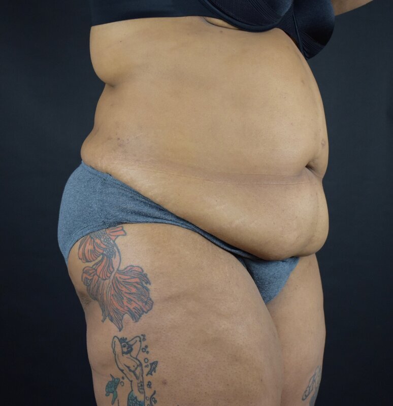 Abdominoplasty w/out Lipo Before & After Image