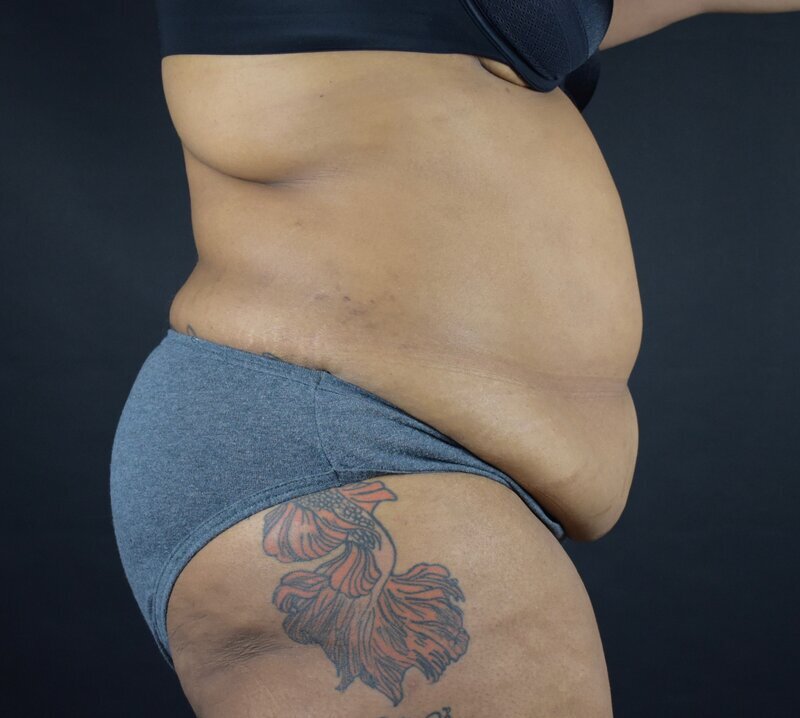 Abdominoplasty w/out Lipo Before & After Image