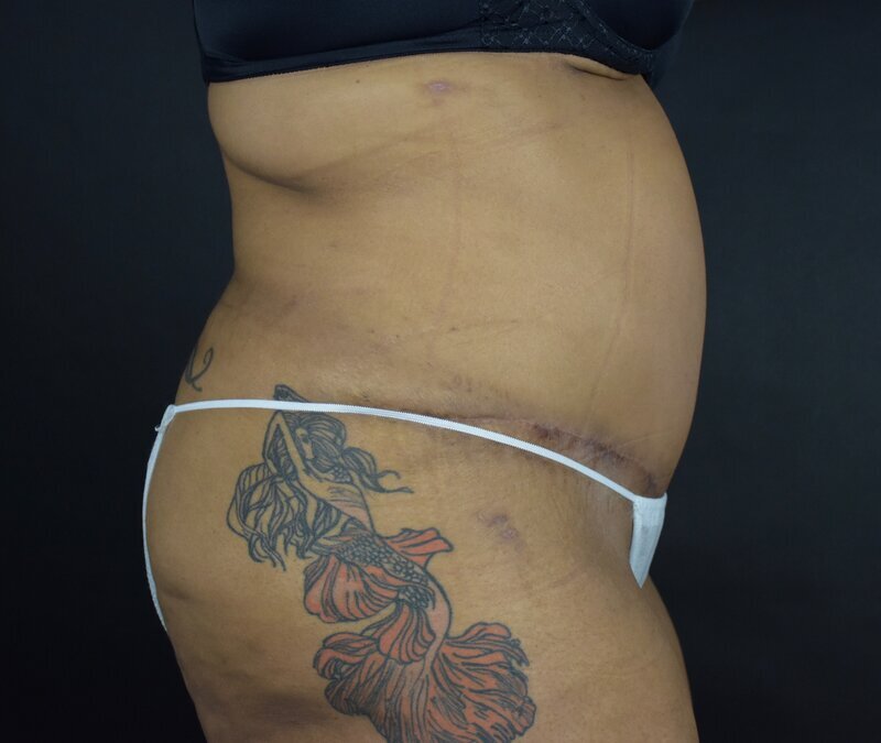 Abdominoplasty w/out Lipo Before & After Image