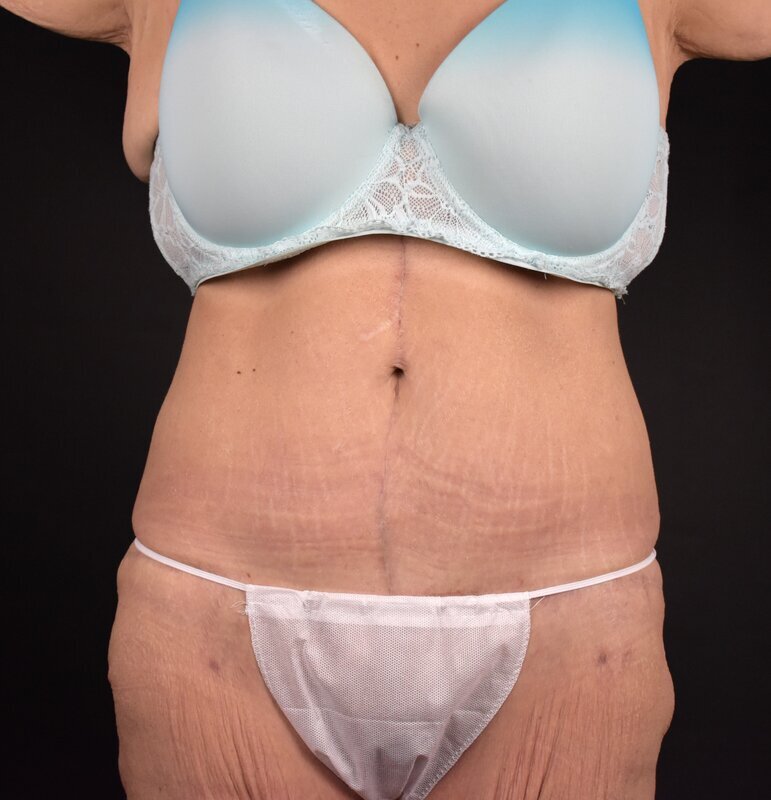 Abdominoplasty w/out Lipo Before & After Image