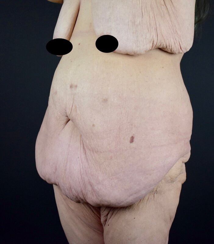 Abdominoplasty w/out Lipo Before & After Image