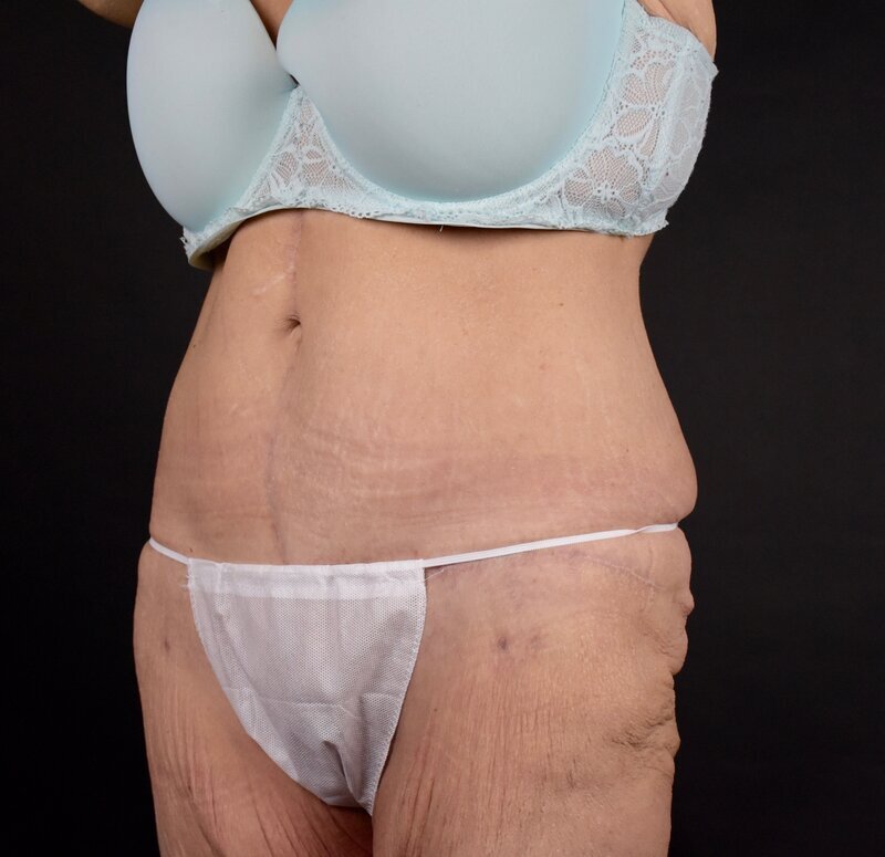 Abdominoplasty w/out Lipo Before & After Image