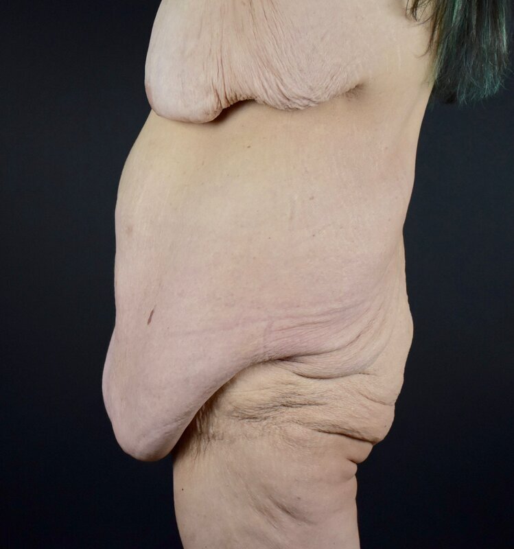 Abdominoplasty w/out Lipo Before & After Image