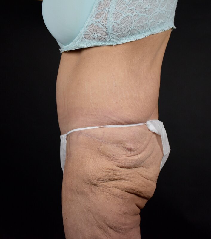 Abdominoplasty w/out Lipo Before & After Image