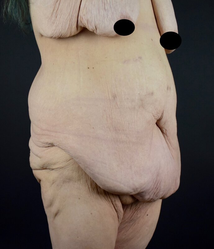 Abdominoplasty w/out Lipo Before & After Image