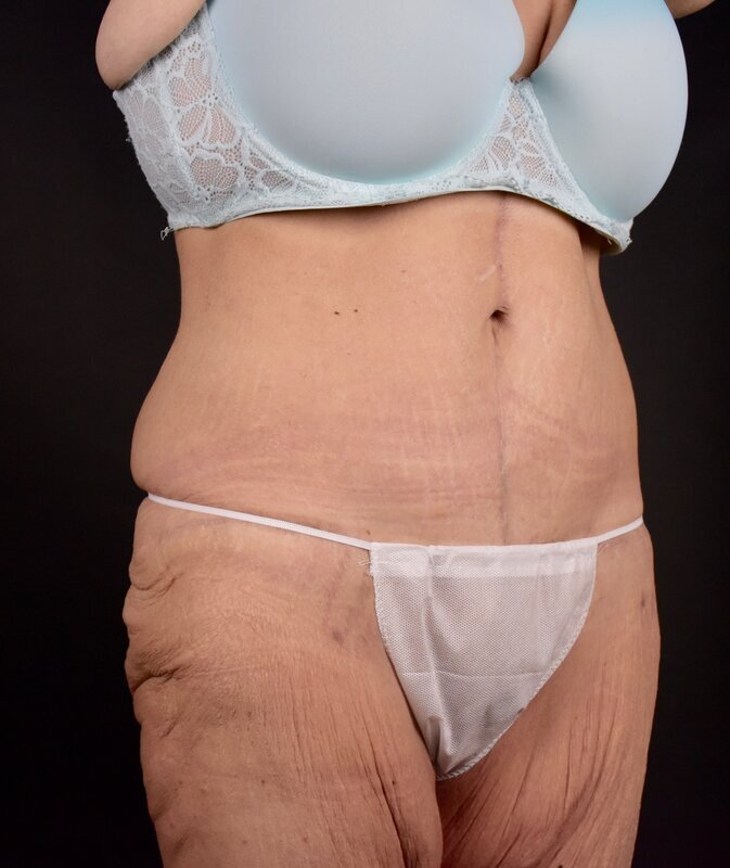 Abdominoplasty w/out Lipo Before & After Image