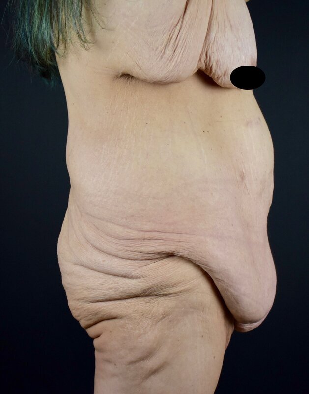 Abdominoplasty w/out Lipo Before & After Image